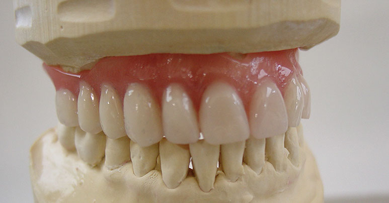 Zahnarztpraxis Dr. Isabel Selmair - München, Schwabing / Zahnersatz, Totalprothese