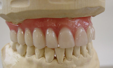 Zahnarztpraxis Dr. Isabel Selmair - München, Schwabing / Zahnersatz, Totalprothese