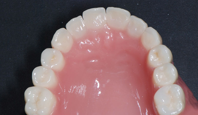 Zahnarztpraxis Dr. Isabel Selmair - München, Schwabing / Zahnersatz, Totalprothese