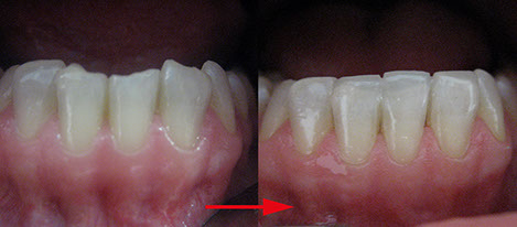 Zahnarztpraxis Dr. Isabel Selmair - München, Schwabing / Ästhetische Rekonstruktionen, Frontzahn