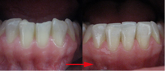 Zahnarztpraxis Dr. Isabel Selmair - München, Schwabing / Ästhetische Rekonstruktionen, Frontzahn