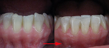 Zahnarztpraxis Dr. Isabel Selmair - München, Schwabing / Ästhetische Rekonstruktionen, Frontzahn