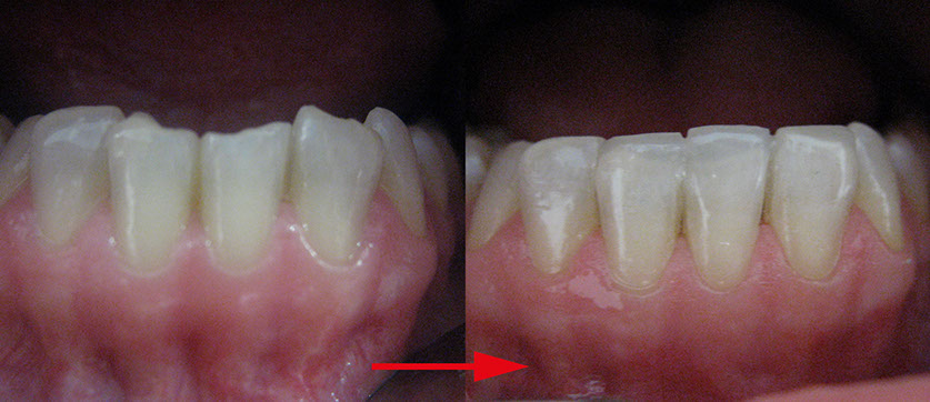 Zahnarztpraxis Dr. Isabel Selmair - München, Schwabing / Ästhetische Rekonstruktionen, Frontzahn