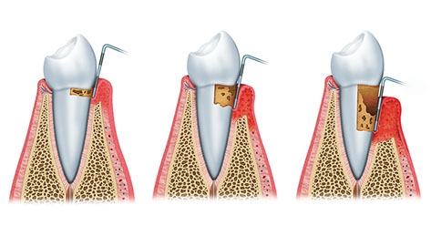 Zahnarztpraxis Dr. Isabel Selmair - München, Schwabing / Parodontitisbehandlung