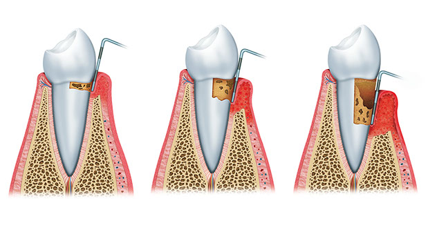 Zahnarztpraxis Dr. Isabel Selmair - München, Schwabing / Parodontitisbehandlung
