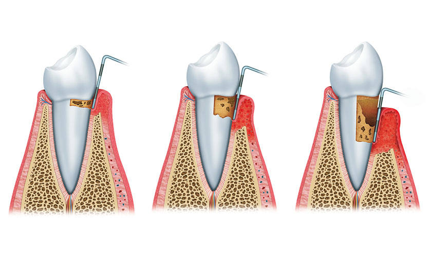Zahnarztpraxis Dr. Isabel Selmair - München, Schwabing / Parodontitisbehandlung