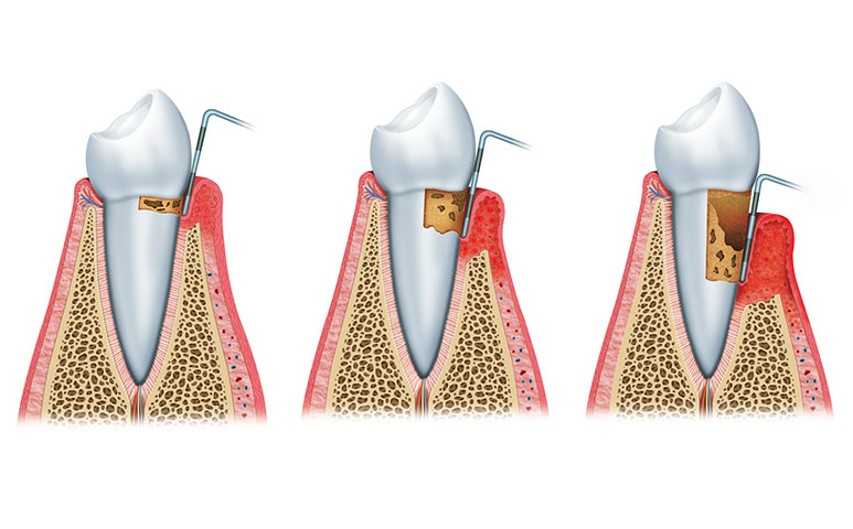Zahnarztpraxis Dr. Isabel Selmair - München, Schwabing / Parodontitisbehandlung