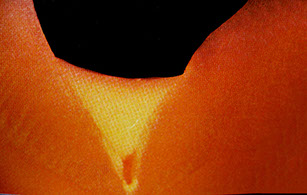 Zahnarztpraxis Dr. Isabel Selmair - München, Schwabing / Vorsorge (Prophylaxe), Fissuren und Versiegelungen