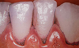 Zahnarztpraxis Dr. Isabel Selmair - München, Schwabing / Vorsorge (Prophylaxe), Professionelle Zahnreinigung