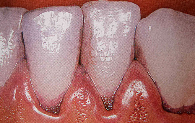 Zahnarztpraxis Dr. Isabel Selmair - München, Schwabing / Vorsorge (Prophylaxe), Professionelle Zahnreinigung