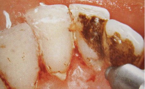 Zahnarztpraxis Dr. Isabel Selmair - München, Schwabing / Vorsorge (Prophylaxe), Professionelle Zahnreinigung