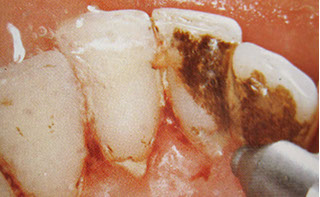 Zahnarztpraxis Dr. Isabel Selmair - München, Schwabing / Vorsorge (Prophylaxe), Professionelle Zahnreinigung