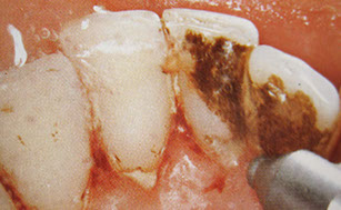 Zahnarztpraxis Dr. Isabel Selmair - München, Schwabing / Vorsorge (Prophylaxe), Professionelle Zahnreinigung