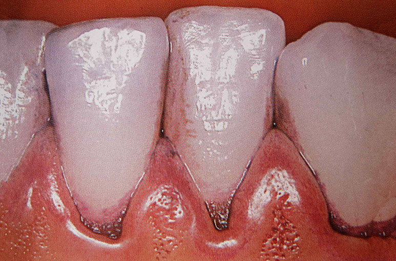 Zahnarztpraxis Dr. Isabel Selmair - München, Schwabing / Vorsorge (Prophylaxe), Professionelle Zahnreinigung